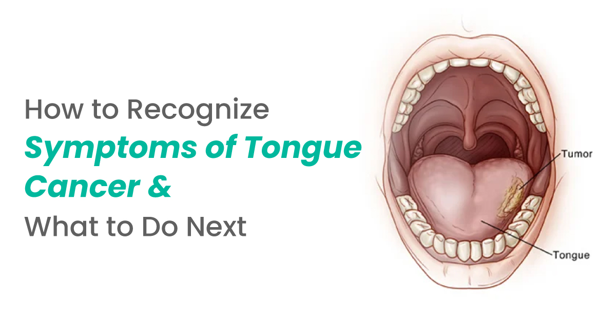 How to Recognize Symptoms of Tongue Cancer and What to Do Next