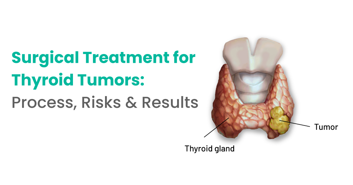 Surgical Treatment for Thyroid Tumors: Process, Risks & Results