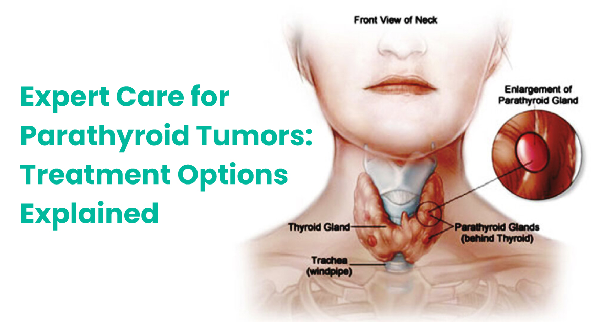 Expert Care for Parathyroid Tumors: Treatment Options Explained