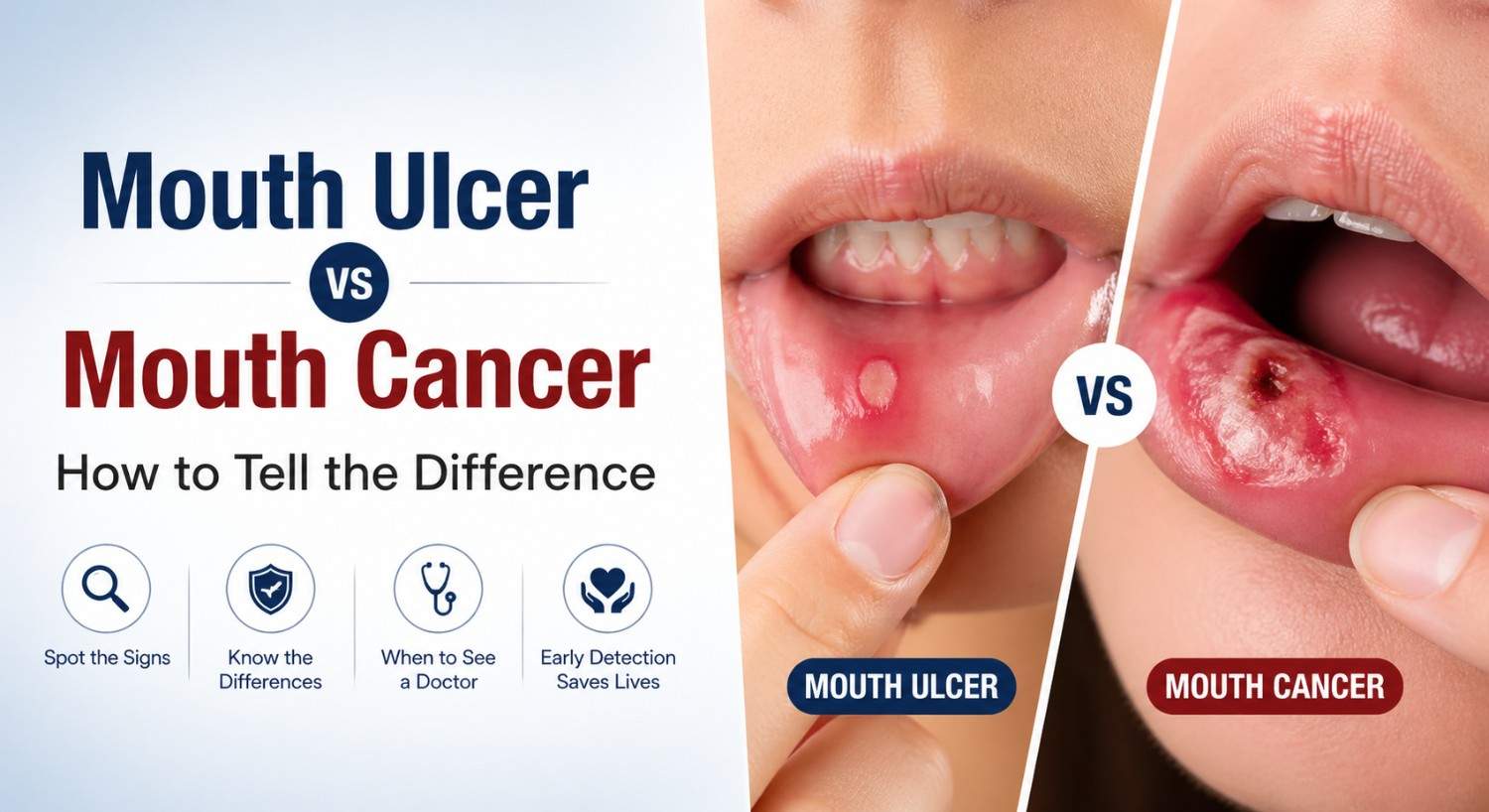 Mouth Ulcer vs Mouth Cancer