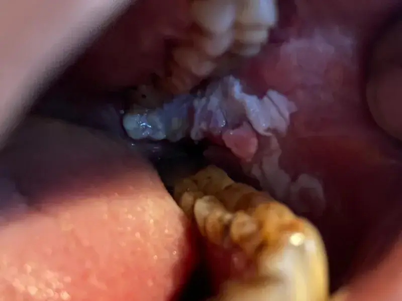 oral_cancer_surgery_in_ahmedabad