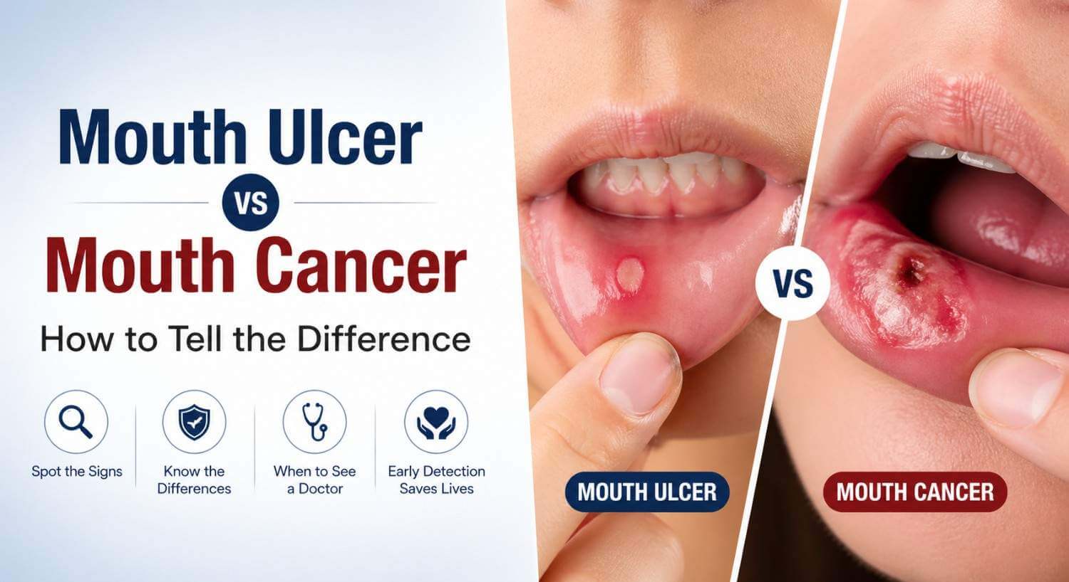 Mouth Ulcer vs Mouth Cancer: How to Tell the Difference